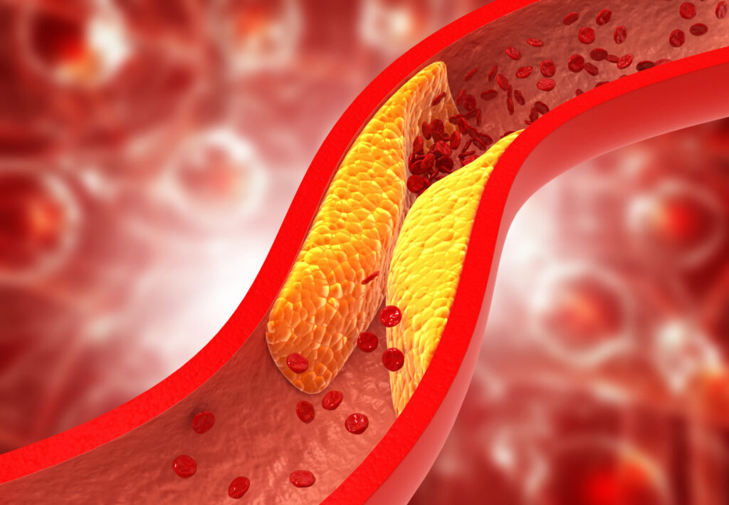 Clogged,Arteries,,Cholesterol,Plaque,In,Artery.,3d,Illustration