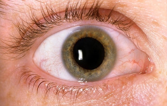 VM-GLAUCOMA
