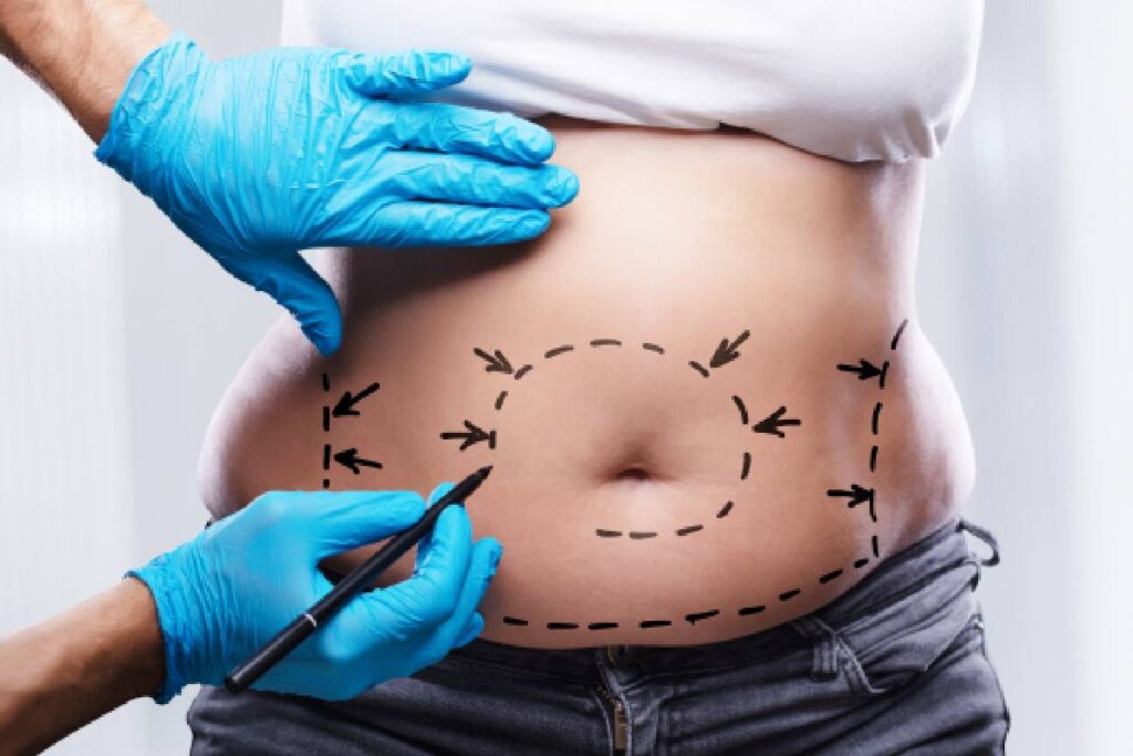 abdominoplastia-lipoaspiracao-diferencas