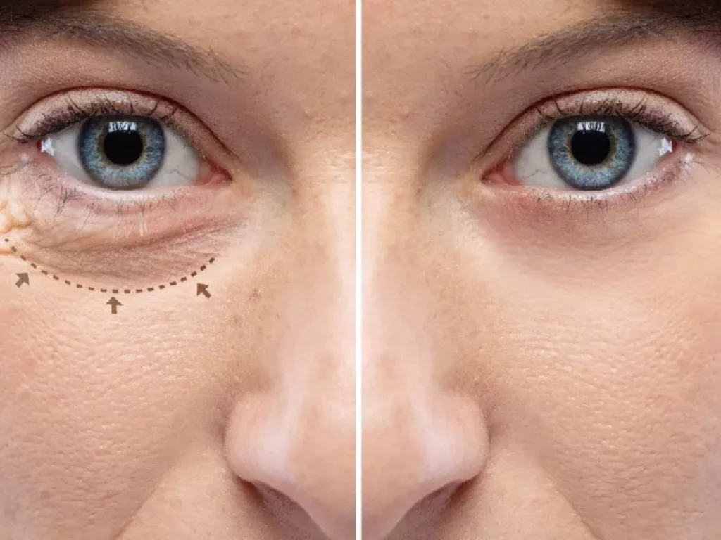 blefaroplastia-o-que-e-cirurgia-1