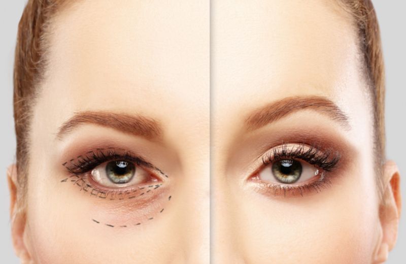 blefaroplastia