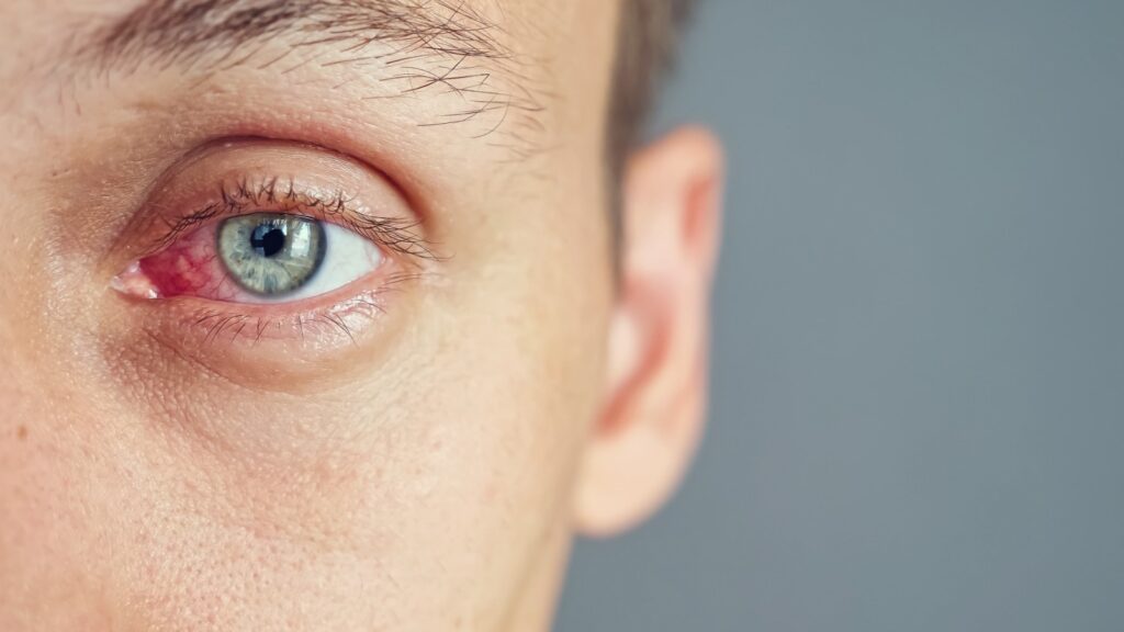 cancer-olhos-melanoma-coroide cancer-olhos-melanoma-coroide