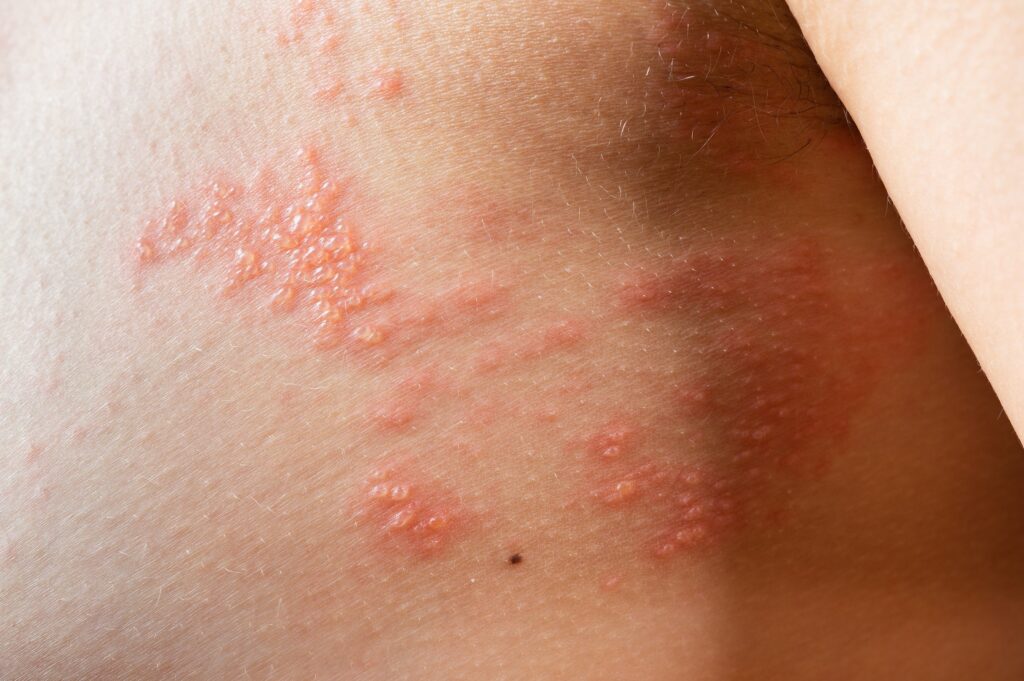 chickenpox rash. Shingles, varicella-zoster virus. skin rash and blisters on body. Skin infected Herpes zoster virus. Herpes Virus on body. urticaria rash. atopic dermatitis chickenpox rash. Shingles, varicella-zoster virus. skin rash and blisters on body. Skin infected Herpes zoster virus. Herpes Virus on body. urticaria rash. atopic dermatitis