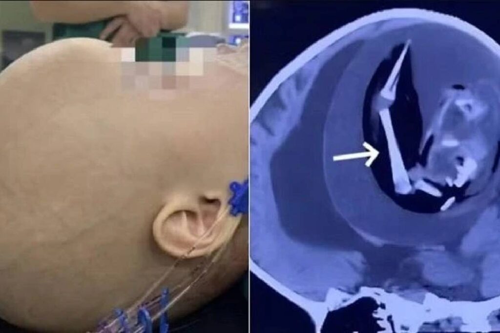 feto-parasita-cranio-bebe feto-parasita-cranio-bebe