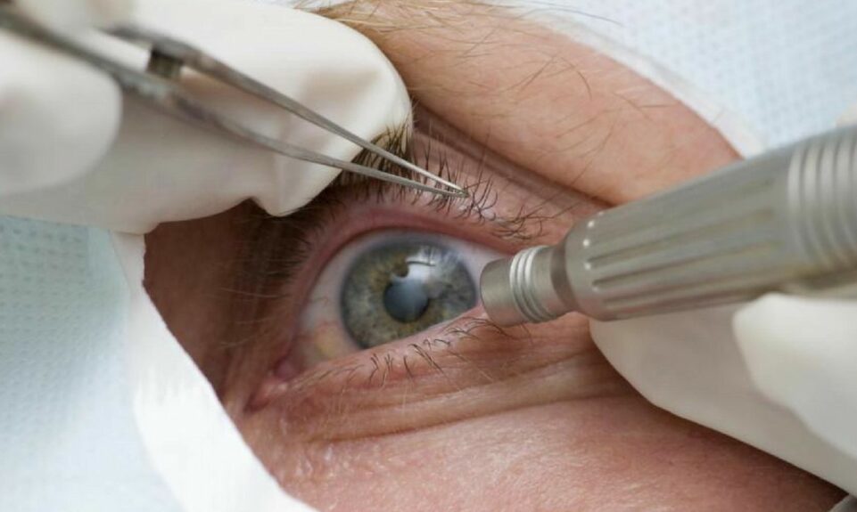 glaucoma-e1623101375514 Divulgação
