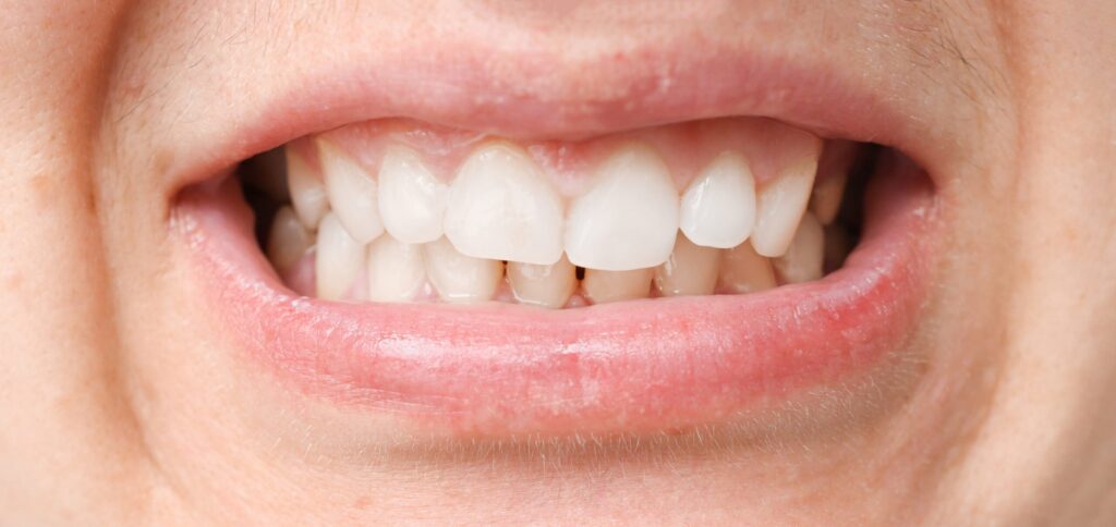 Mouth with white teeth, malocclusion, health problem. Close-up occlusion, misalignment. Mouth with white teeth, malocclusion, health problem. Close-up occlusion, misalignment.