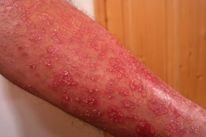 psoriasis-356429_1920-e1624393304708