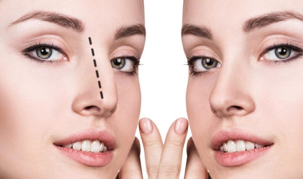 rinoplastia