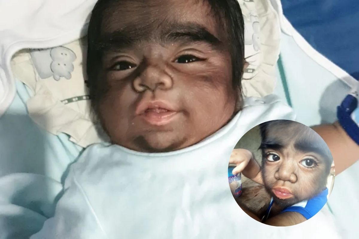 'Bebê mais peludo do mundo' tem Síndrome do Lobisomem - Massa News