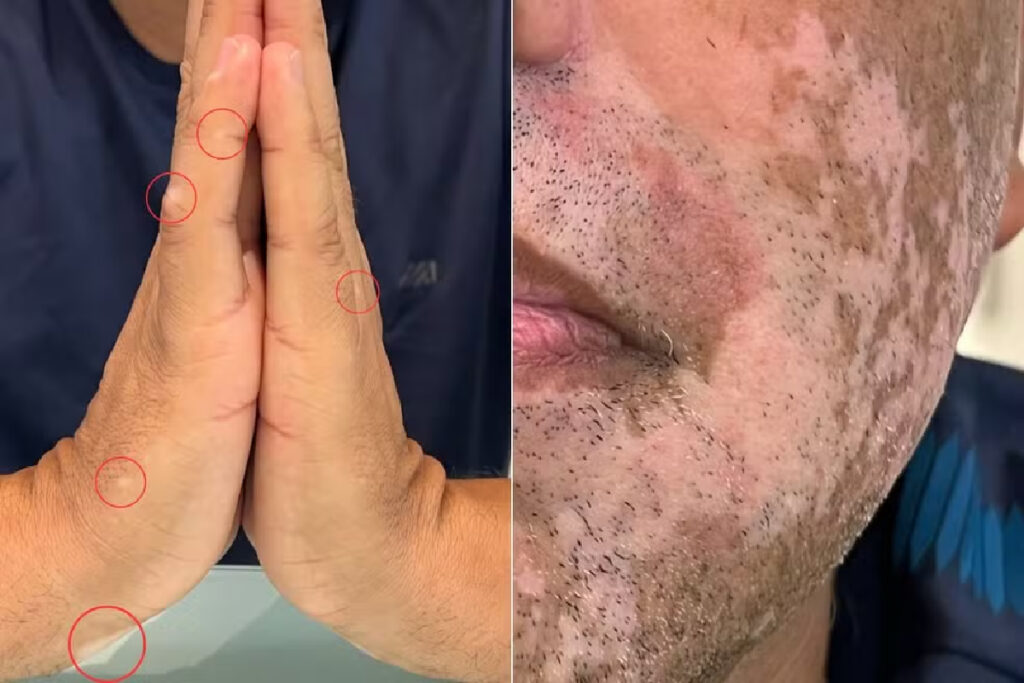 vitiligo-divorcio-desaparece