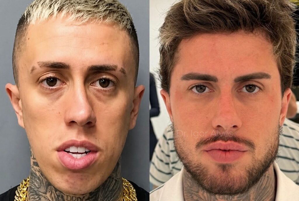 Antes e depois de MC Daniel