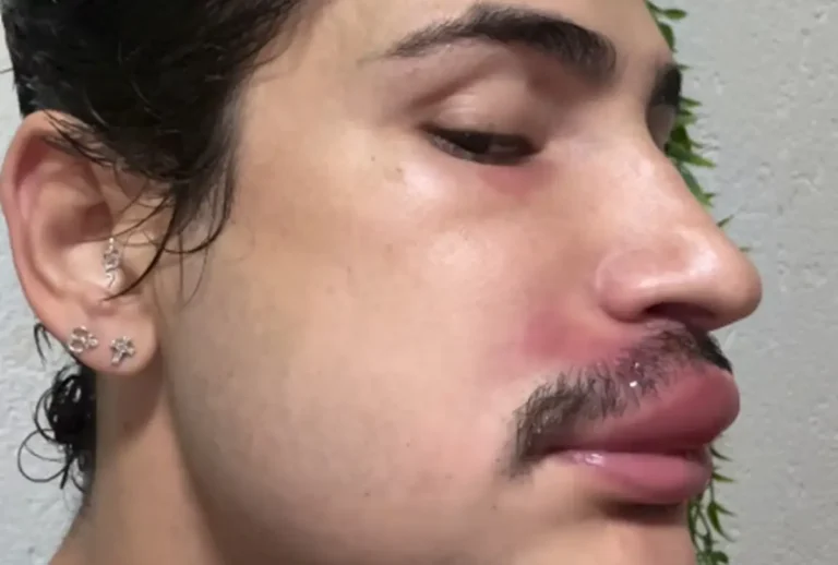 Espinha vira infecção