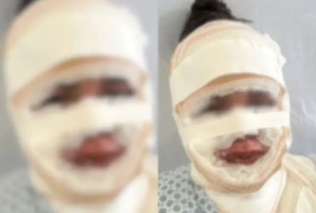 Uma mulher de 32 anos foi presa após jogar água fervente no rosto da atual namorada de seu ex-companheiro.